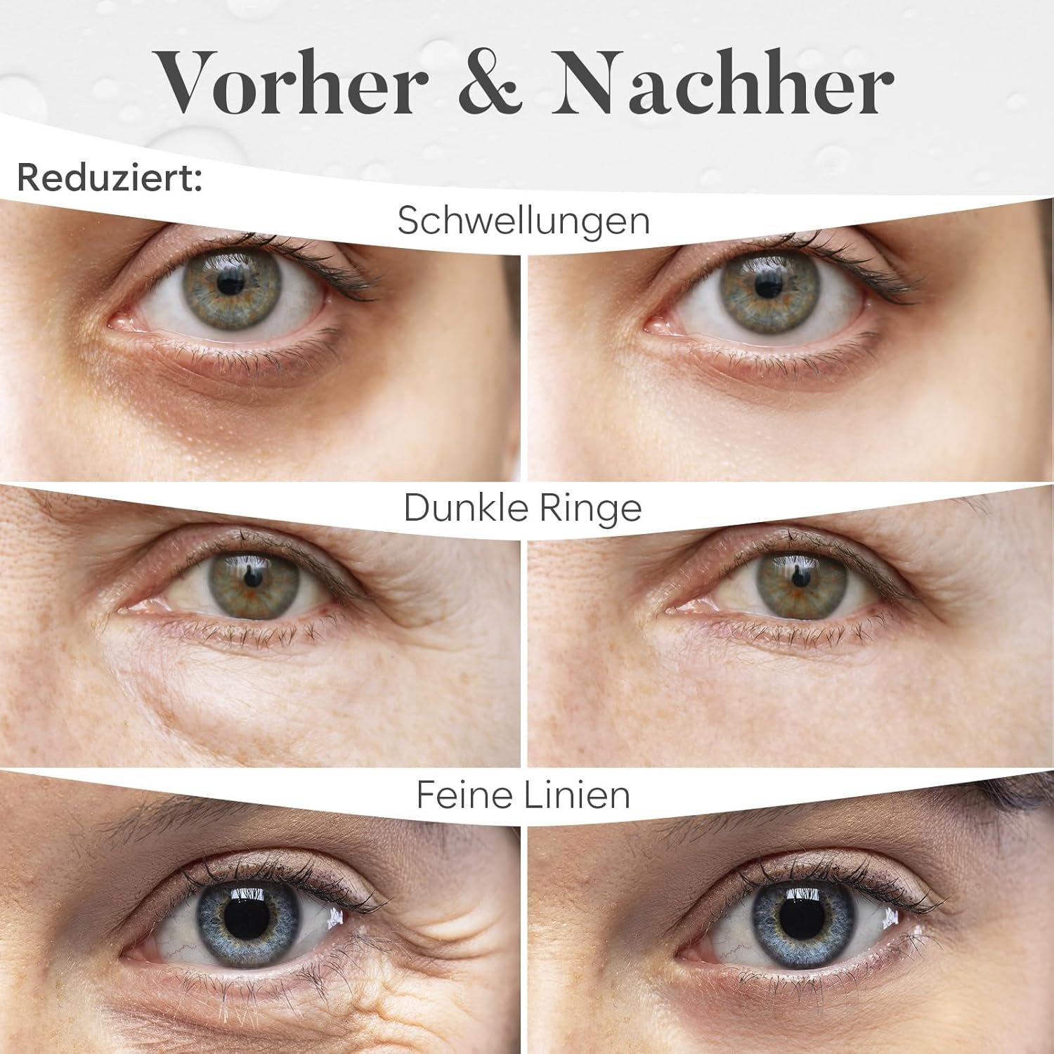 Vorher-Nachher-Vergleich der Augenpartie: Schwellungen, dunkle Ringe und feine Linien reduziert