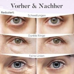 Vorher-Nachher-Vergleich der Augenpartie: Schwellungen, dunkle Ringe und feine Linien reduziert