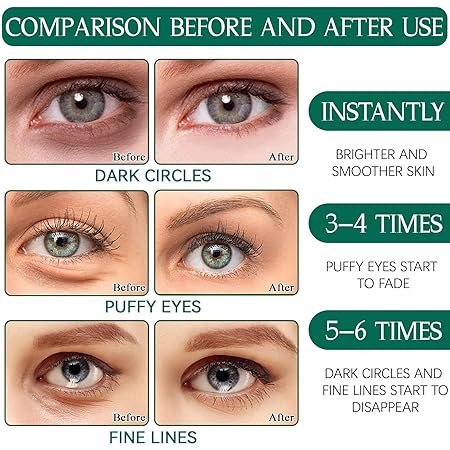 Vorher-Nachher-Vergleich: Augen mit weniger Augenringen, Schwellungen und Fältchen
